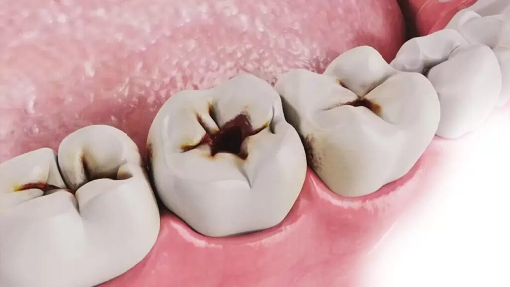 Çürük Diş Nasıl Tedavi Edilir